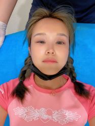 体验前-海涛医疗美容·面部抗衰·注射美鼻