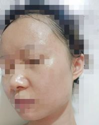 体验后-比华利美容医院