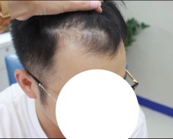 -大麦微针植发全国连锁