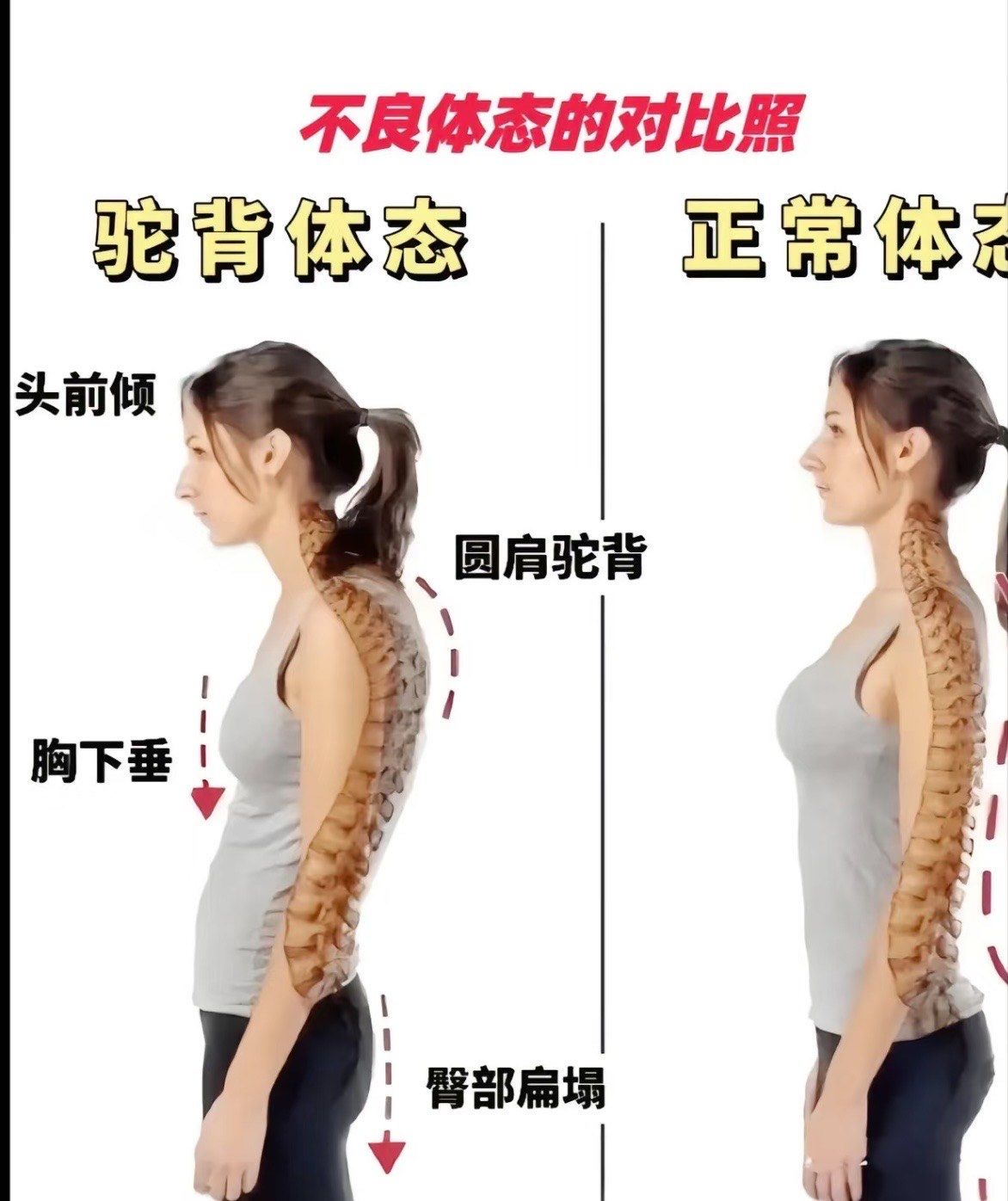 圆肩驼背毁所有