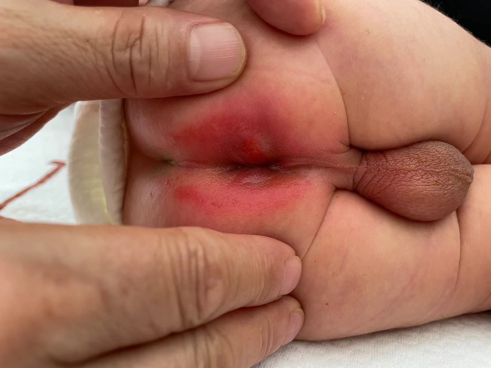 乳糖消化不良致使新生儿腹泻,这种腹泻极容易造成臀部皮肤感染,如不