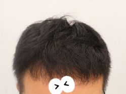 -大麦微针植发全国连锁