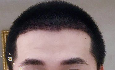 -大麦微针植发丨全国连锁