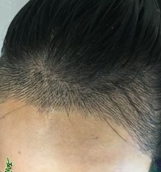 -大麦微针植发丨全国连锁