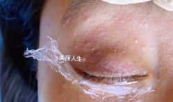 -爱莎扁平疣·汗管瘤·斑痣中心