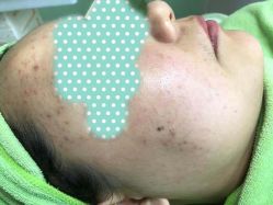 -苗医生草本科技祛痘