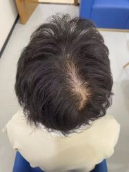 -大麦微针植发全国连锁