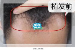 -大麦微针植发全国连锁