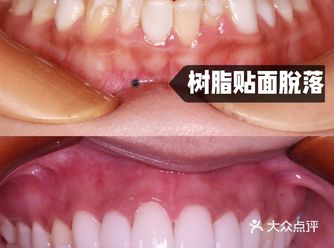树脂贴面为什么没有全瓷贴面好？
