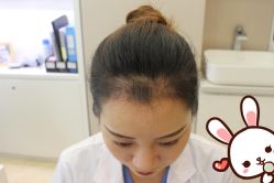 点击看大图 -大麦微针植发丨全国连锁