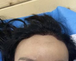 -碧莲盛·不剃发植发