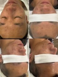 -塑青春&伊肤泉祛痘皮肤管理