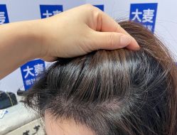 -大麦微针植发丨全国连锁