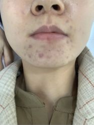 -蕾特恩专业祛痘国际连锁