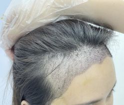 -大麦微针植发丨全国连锁