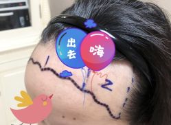 -大麦微针植发全国连锁