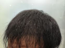 -碧莲盛·不剃发植发