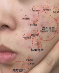 -瑶芳清颜草本祛痘