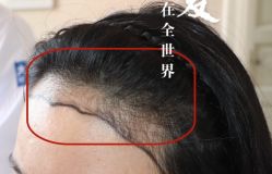 -大麦微针植发全国连锁