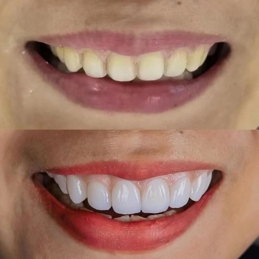 亮白牙齿自然闪耀