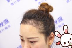 -大麦微针植发丨全国连锁