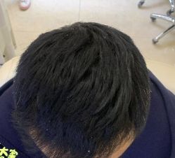 -大麦微针植发丨全国连锁