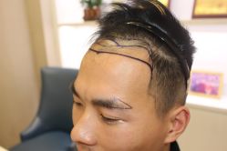 -大麦微针植发丨全国连锁