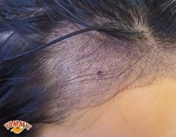 -大麦微针植发丨全国连锁