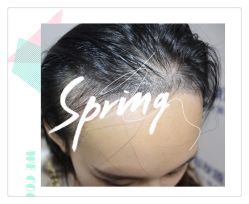 -大麦微针植发全国连锁