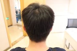 -大麦微针植发丨全国连锁