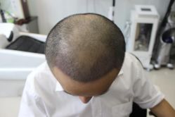 -大麦微针植发丨全国连锁