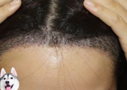 -大麦微针植发丨全国连锁