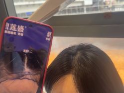 -碧莲盛·不剃发植发