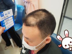 -大麦微针植发丨全国连锁