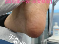 -Andrew指甲专科灰指甲·甲沟炎矫正·3D步态矫形鞋垫定制(浦三路店)