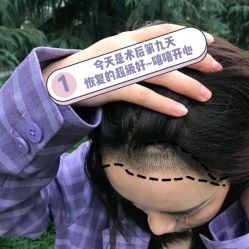 -碧莲盛·不剃发植发