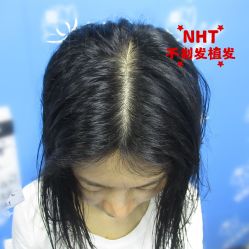 -碧莲盛·不剃发植发
