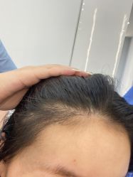 -大麦微针植发全国连锁