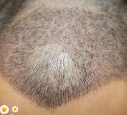 -大麦微针植发丨全国连锁