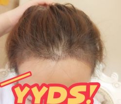 -大麦微针植发丨全国连锁