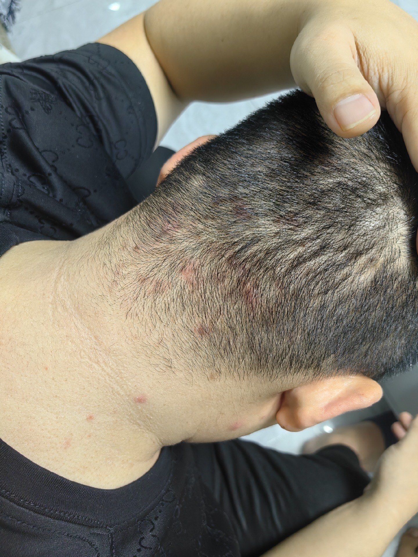 病原体微生物得以在头皮旺盛繁衍,给毛囊发炎提供便捷.
建议:1,去专