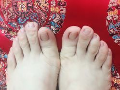 点击看大图 -德哥灰指甲脚气甲沟炎跖疣护理