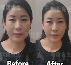 -颜和骨正&明星徒手小颜整骨