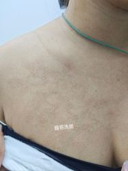 -净肤洗纹身