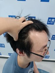 -大麦微针植发全国连锁
