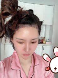 点击看大图 -大麦微针植发丨全国连锁