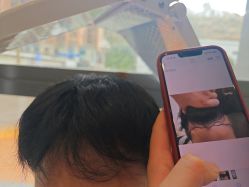 -碧莲盛·不剃发植发