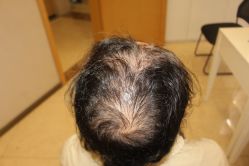 -大麦微针植发丨全国连锁