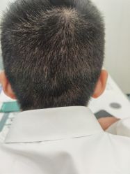 -大麦微针植发全国连锁