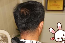 点击看大图 -大麦微针植发丨全国连锁